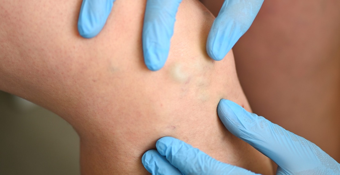 Especialidad en Flebología - Centro de Especialidades Médicas DaLuz